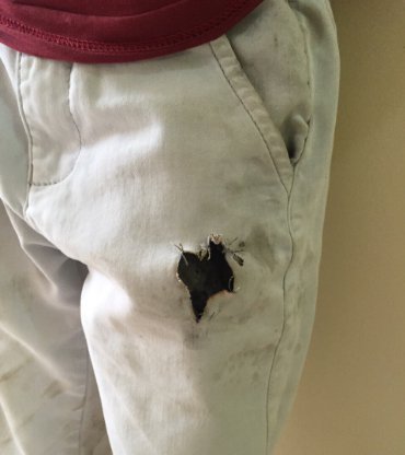 iPhone 6 взорвался у мальчика в кармане, нанеся серьезные ожоги