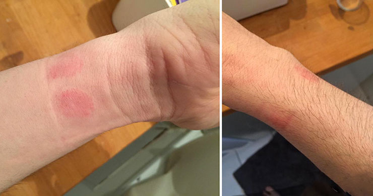 Владельцы Apple Watch жалуются на аллергию и раздражение кожи